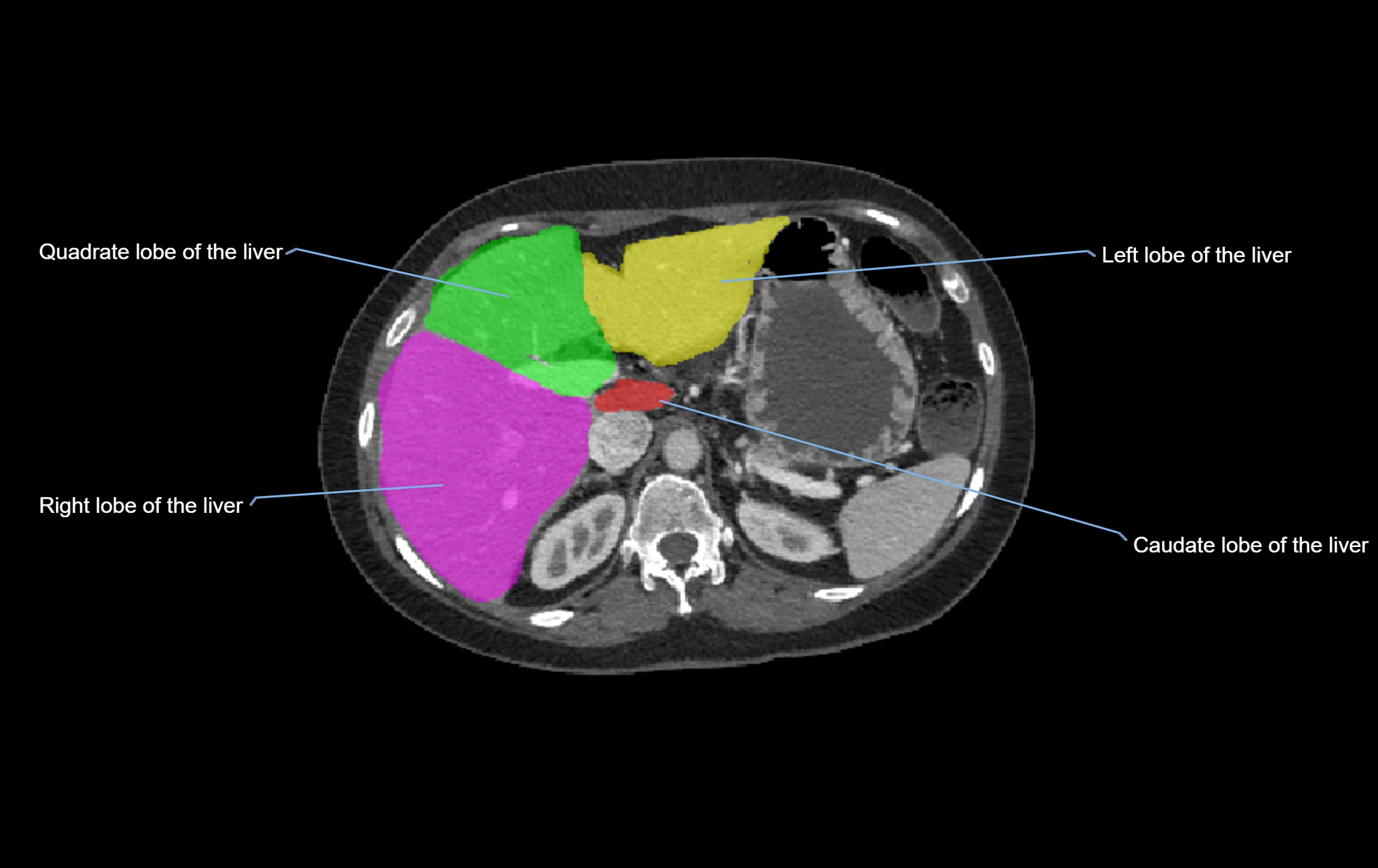 CT lliver lobes axial cross sectional anatomy labelled image -00047.webp